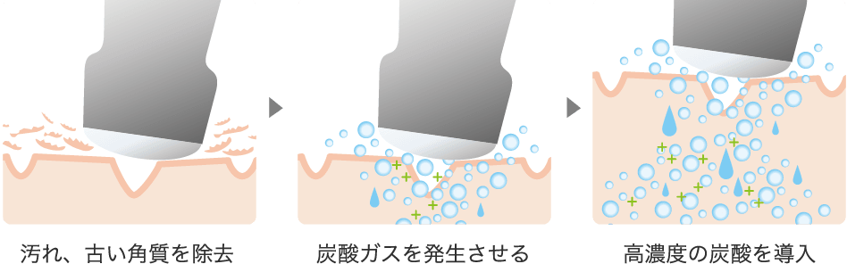 炭酸導入・マッサージ