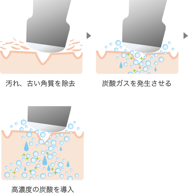 炭酸導入・マッサージ